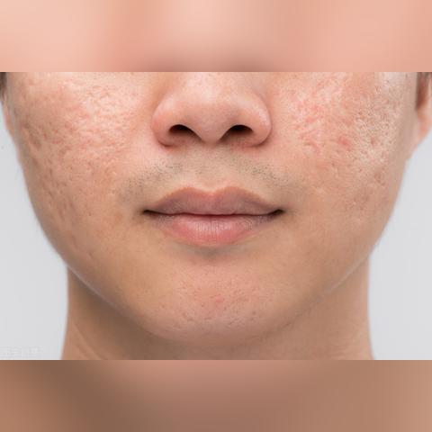 最新Plasma去痘坑技术,重塑肌肤的理想之选