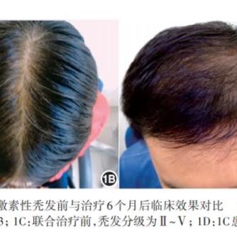 治疗脱发最新临床技术揭秘